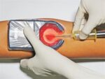 VeinSpy vein detector