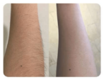 Epilite Pro LASER Πριν-Μετά