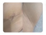 Διοδικό Laser αποτρίχωσης Epilite Pro