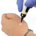 Συσκευή κρυοπηξίας στυλό - Cryopen X+ χρήση