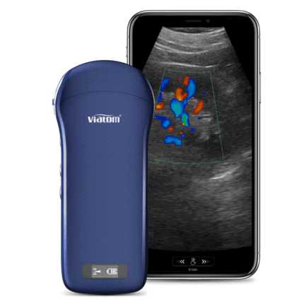 Υπέρηχος φορητός Viatom 3 in 1
