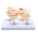 csm_139062_HeineScientific_Bandscheibenmodell_1_34f679deae