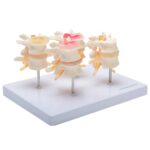 csm_139062_HeineScientific_Bandscheibenmodell_2_2ef00393a9