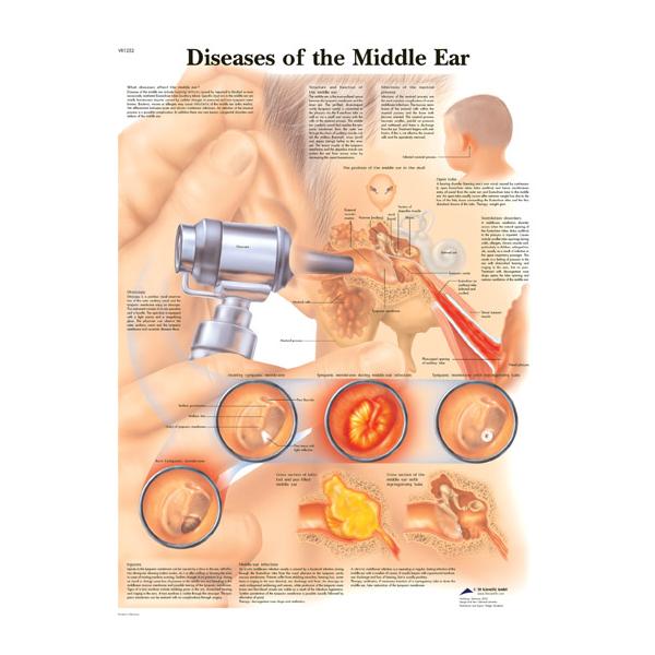 Anatomy chart of middle ear diseases