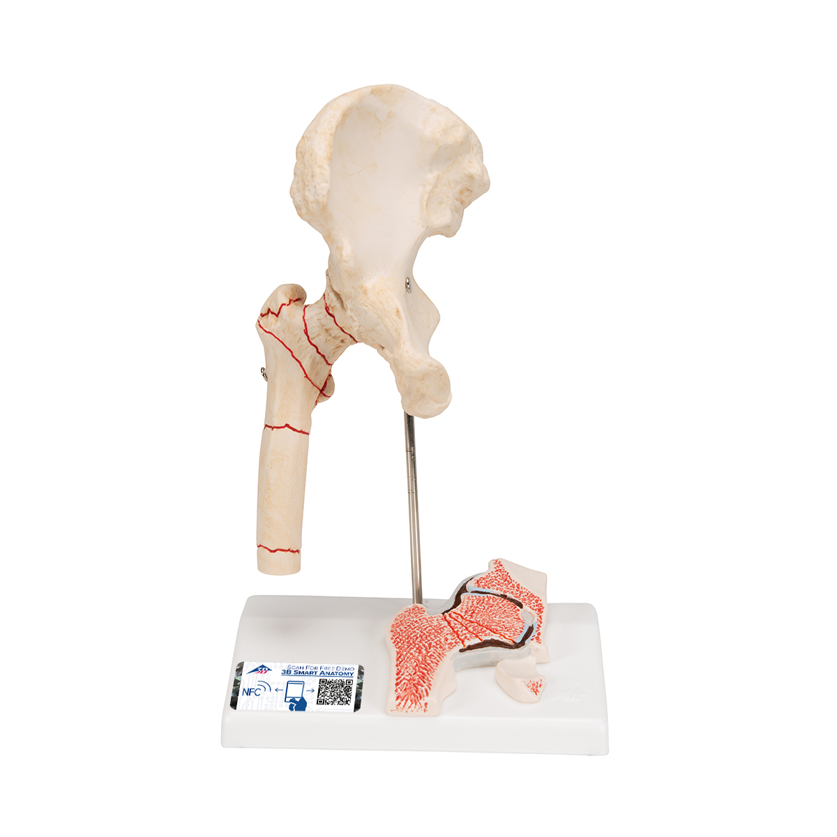 Femur fracture and hip osteoarthritis model 1000175